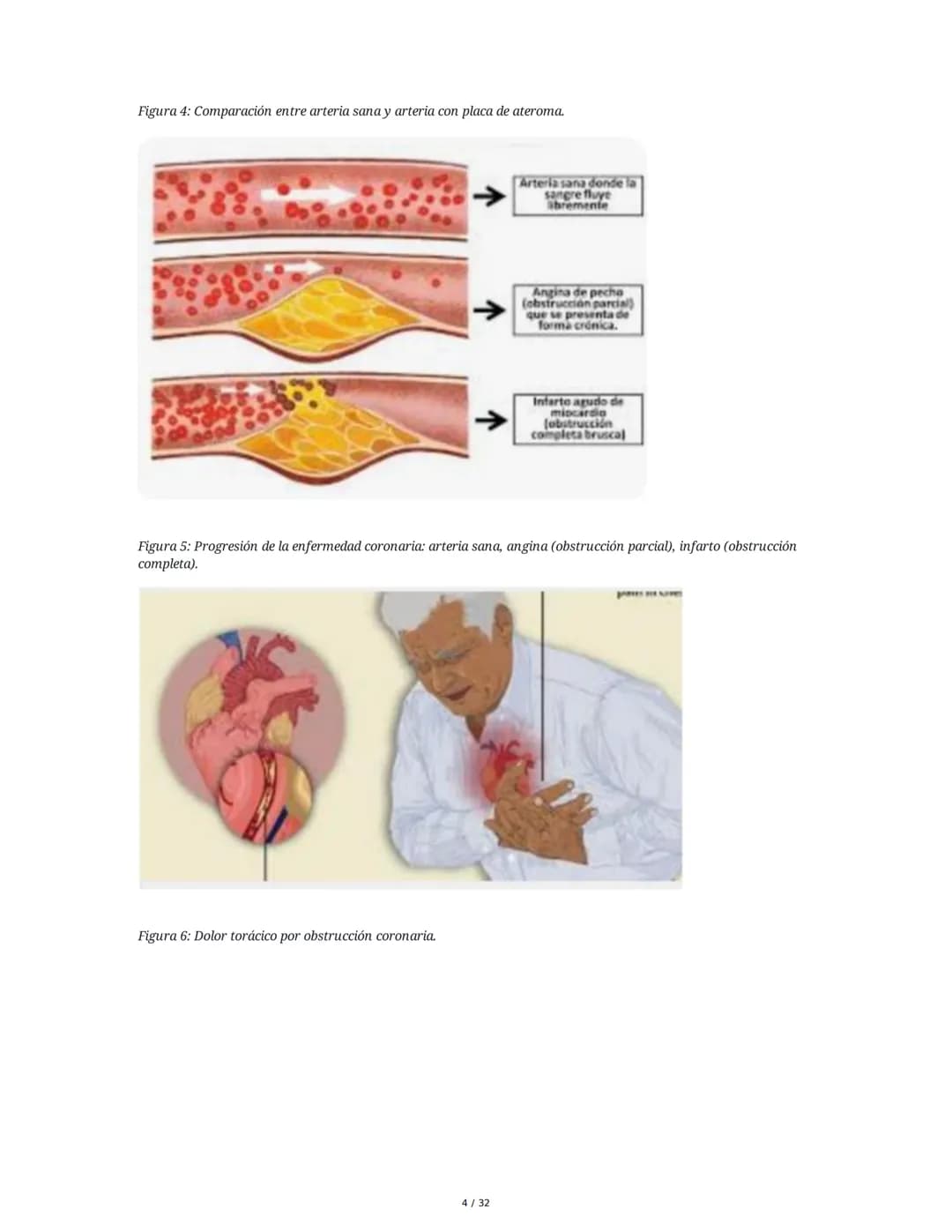 ## Cardiopatía Coronaria

### 1. Introducción y Anatomía de la Circulación Coronaria

La cardiopatía coronaria es una enfermedad crónica del