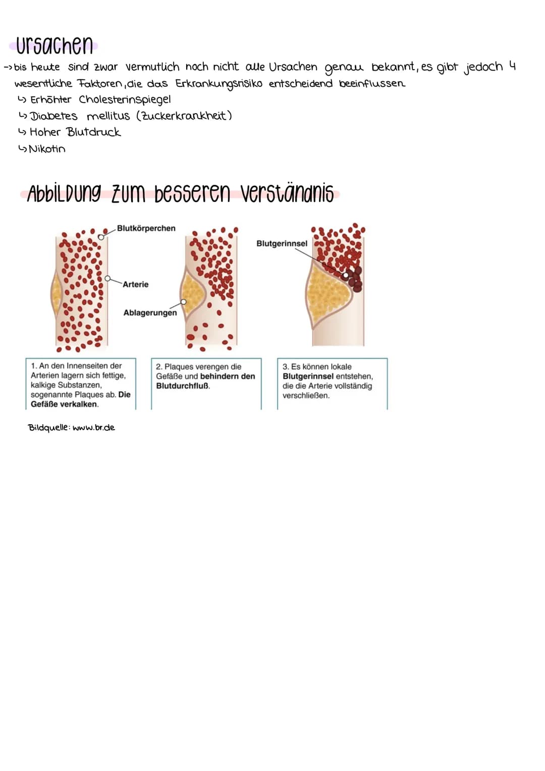 # Arteriosklerose

Definition
- Arteriosklerose umgangssprachlich: Arterienverkalkung
- Erklärung der Schlagadern im Körper (Arterien)
- Blu