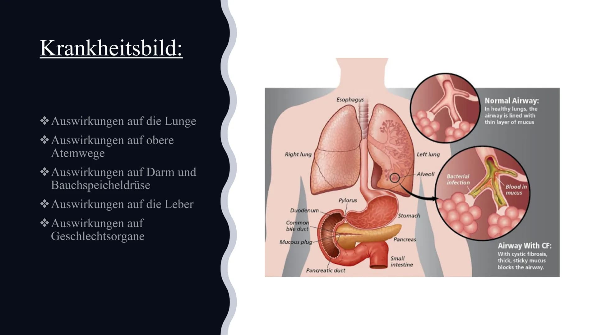 # Mukoviszidose

Von Celine und Nisa Gliederung:

◆Definition
◆Symptome
◆Ursachen
Krankheitsbild
◆Vererbung
◆Lebenserwartung/Vorkommen
◆Die 