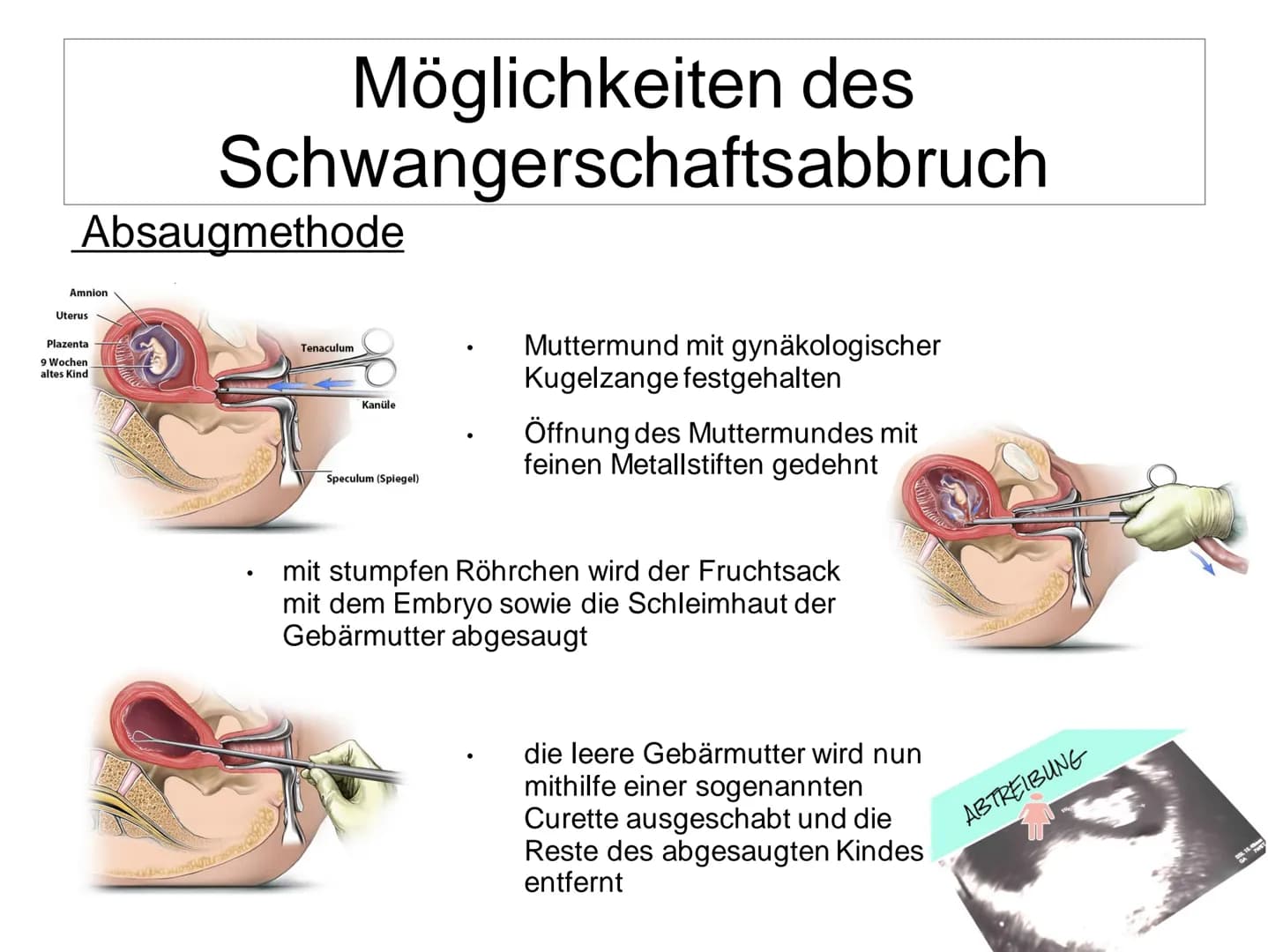 # Schwangerschaftsabbruch

GYNÄKOLOGEN

ZEITDRUCK

VERURTEILUNG

BERATUNGSPFLICHT # Schwangerschaftsabbruch

Gliederung:

*   Allgemein
*   
