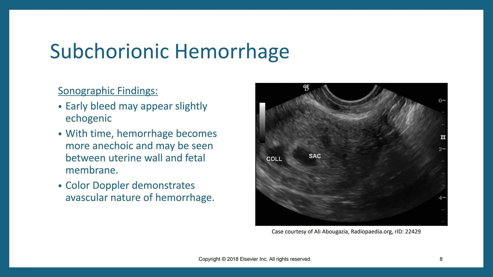 # FIRST-TRIMESTER
# COMPLICATIONS
DMS 202 – OBGYN Sonography I
Fall 2024
Chapter 50
Copyright © 2018 Elsevier Inc. All rights reserved.