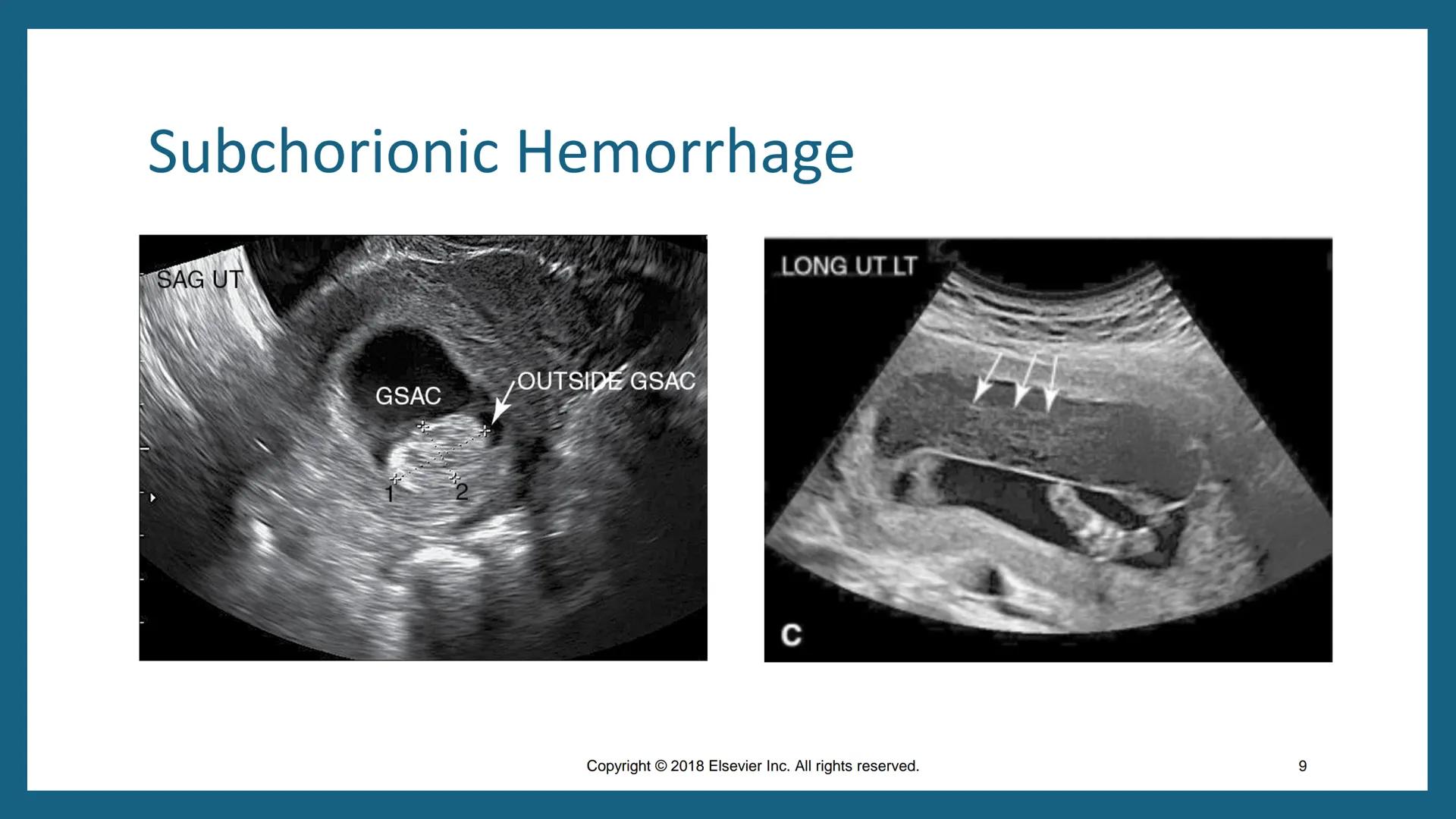 # FIRST-TRIMESTER
# COMPLICATIONS
DMS 202 – OBGYN Sonography I
Fall 2024
Chapter 50
Copyright © 2018 Elsevier Inc. All rights reserved.