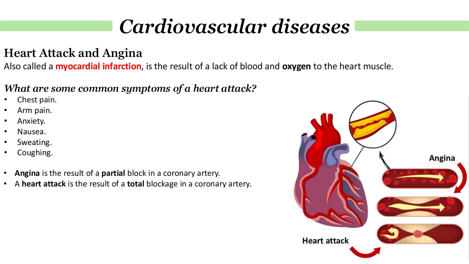 # Cardiovascular diseases
The cause of coronary heart disease (CHD).
1. Layers of fatty material build up inside coronary arteries (vessels