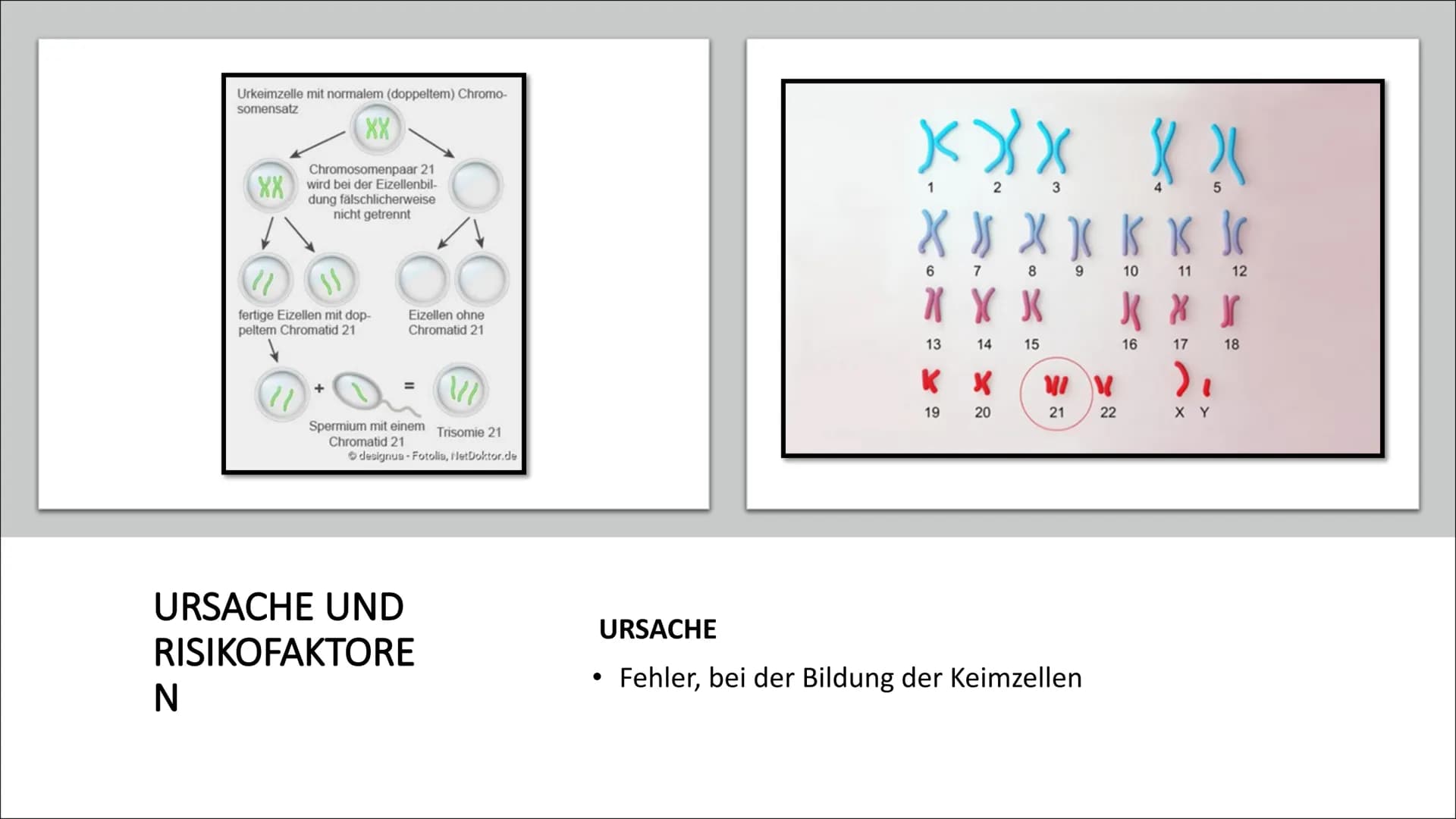 # DOWN-SYNDROM
Trisomie 21 • Was ist Trisomie 21?
• Entdeckung
• Ursache und Risikofaktoren
• Die drei unterschiedlichen Formen der Trisomi
