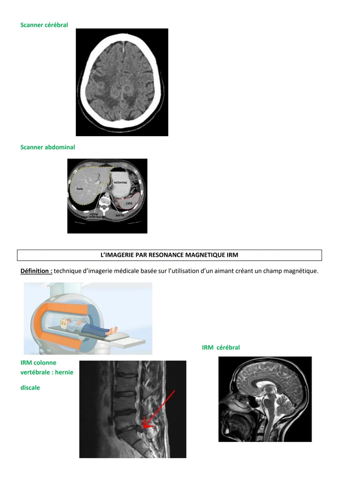 LA TOMODENSITOMETRIE ou SCANNER
Définition: technique d'imagerie médicale basée sur l'utilisation des rayons X qui tournent autour du
patie